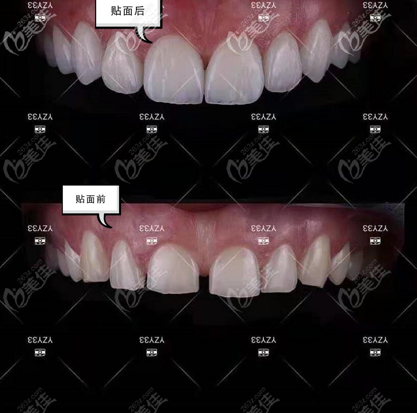 做了6d纳米炫齿浮雕后悔了后遗症很严重想问下怎么拆掉