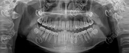 看牙前拍口腔全景片可以更清晰的了解牙齿情况