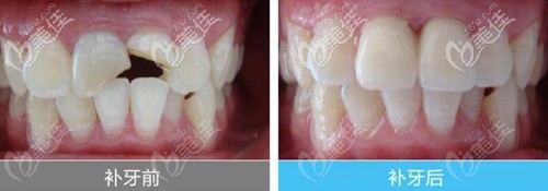 补牙用的德国voco树脂和美国3m哪个好?各自的优点是啥