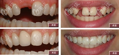 单颗/多颗牙缺失韩国种植牙效果图