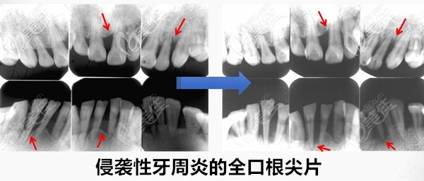 侵袭性牙周炎的全口根尖片