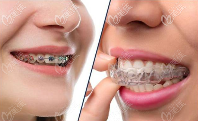 牙齿矫正选隐适美和传统钢牙套哪个效果好隐形快还是钢牙快