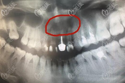 我这牙根尖囊肿因为牵扯到牙根比较多,再加上已经出现了牙槽骨吸收的
