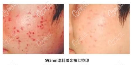 请问595nm脉冲染料激光对痘印有用吗?