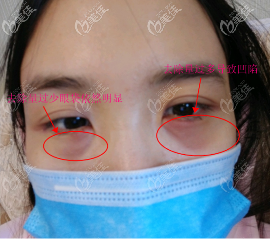 内切去眼袋的风险之一就是做完手术后出现凹陷或者眼袋依旧存在,这是