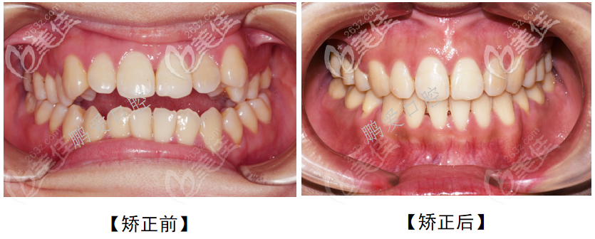 广州博爱口腔门诊部开颌牙齿矫正案例