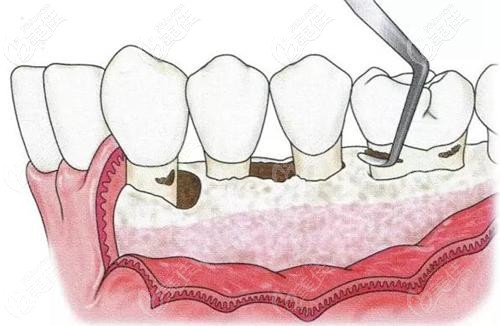 第 一阶段:基础治疗运用常规的牙周治疗方法,去除各种可能的致病因素