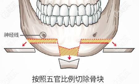 国字脸做长曲线下颌角截骨手术能缩短下巴吗看实例参考