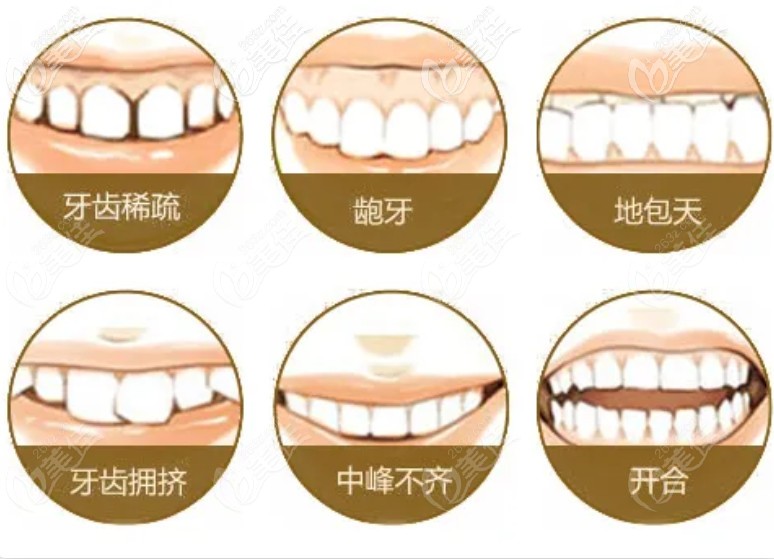 接下来我们就来看看隐适美隐形矫正适合哪种牙齿类型?