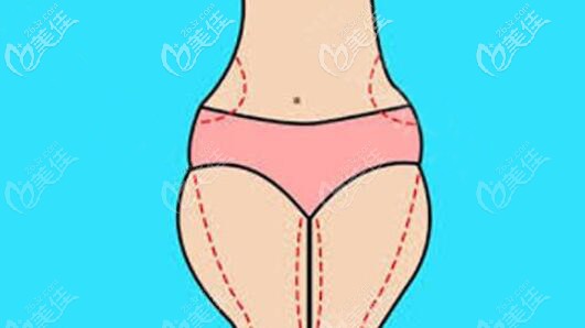 脂肪堆积在大腿和臀部凹凸不平如果抽取大腿脂肪填充到臀部效果怎么样