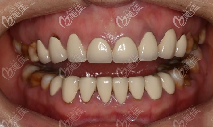 这有韩国橡树牙科做上半口8颗超薄牙贴面美白牙齿效果