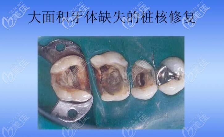 牙齿打桩用金属好还是纤维好修复前先看金属桩和纤维桩的区别及优缺点