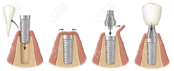 种植牙的过程