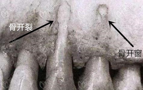 牙齿矫正过程中的骨开窗和骨开裂的区别是什么治疗方式一样吗