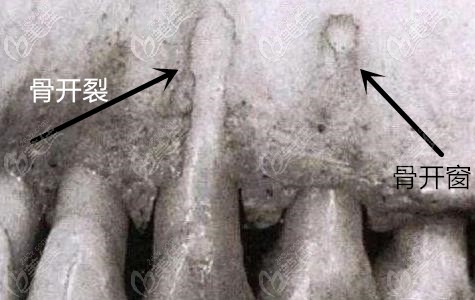 牙齿矫正过程中的骨开窗和骨开裂的区别是什么,治疗方式一样吗