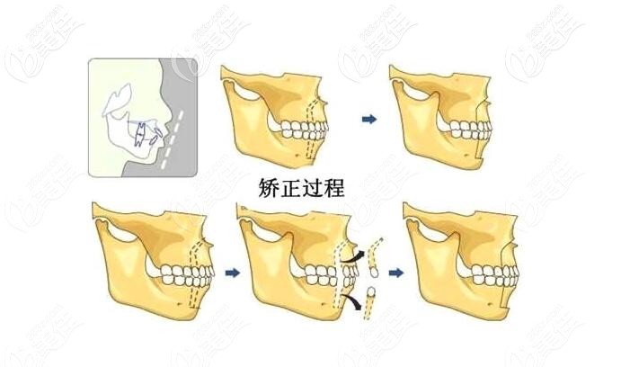 隐形牙套是怎么让牙齿移动的呢讲讲牙齿矫正中牙根移动的原理