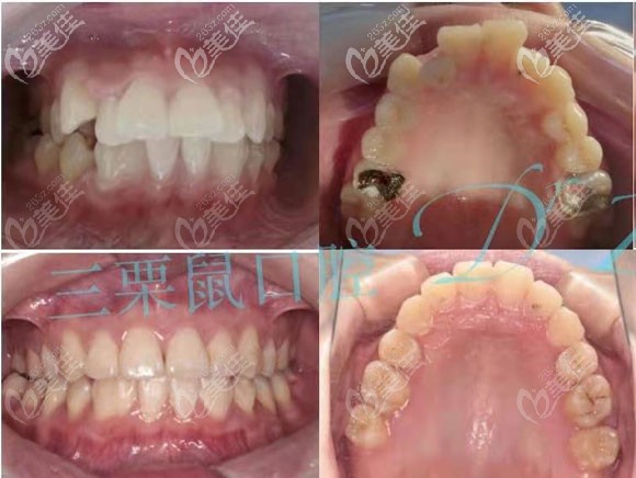 来自福州三栗鼠口腔的分享通过牙齿正畸将智齿前移代替大牙的成功案例