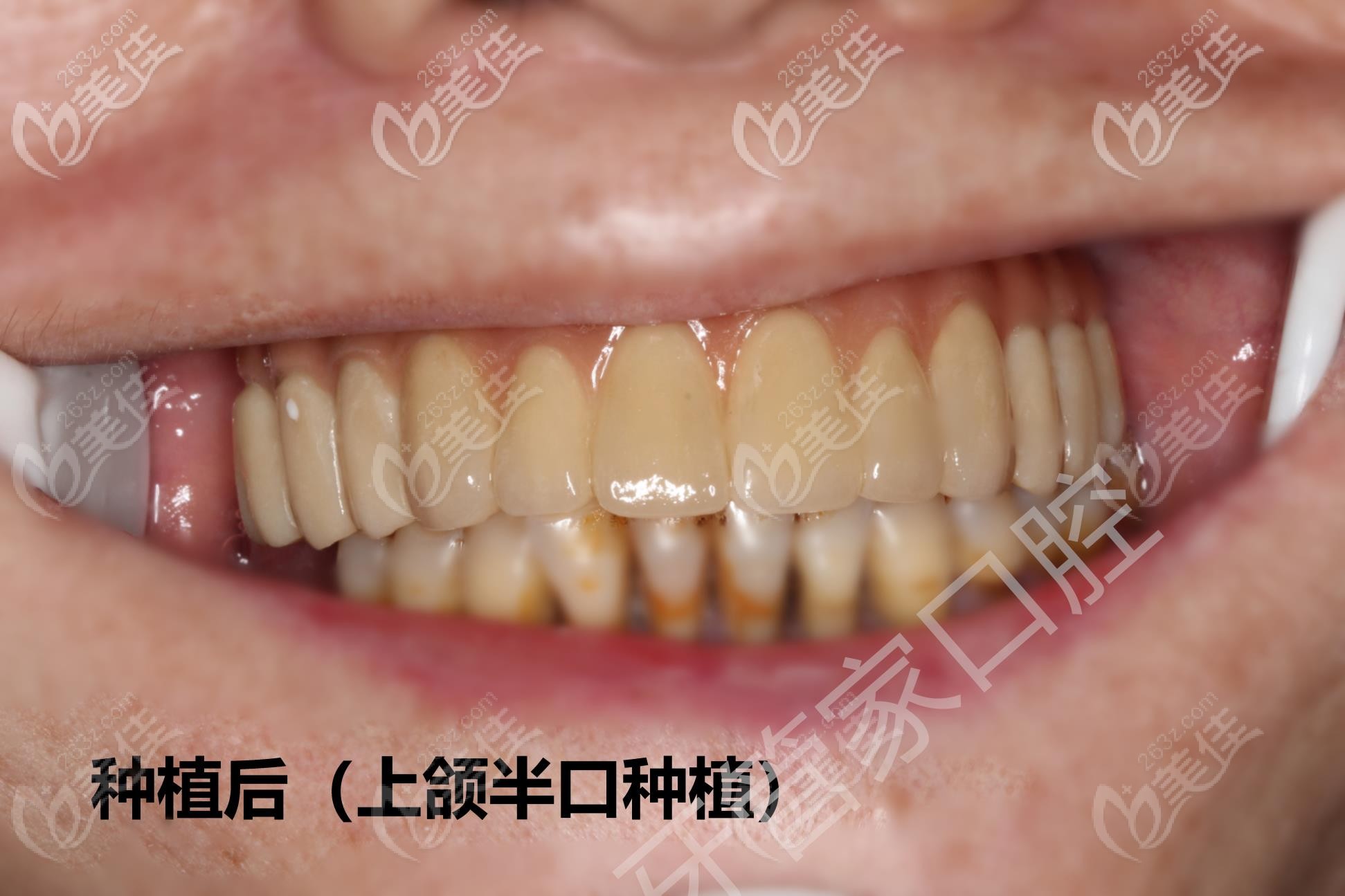 北京西城区的牙管家口腔医院做半口种植牙靠谱吗快看案例