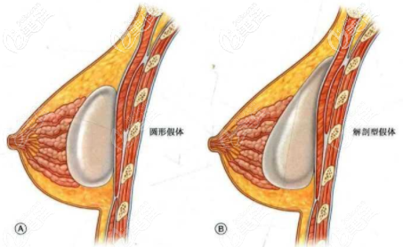 运动丰胸不能让乳房增大好方法中建议做假体隆胸或自体脂肪丰胸比较好