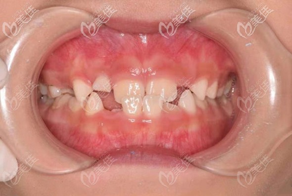 可能有些家长还不知道,这种牙齿症状的专业名叫反颌,是会影响孩子的