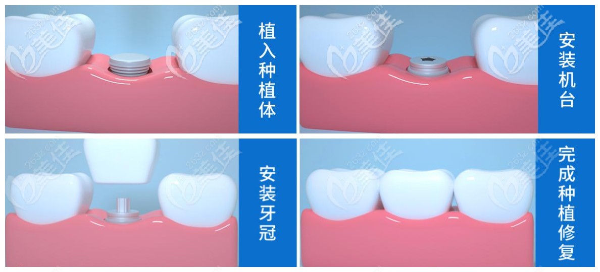 微创种植牙的过程步骤