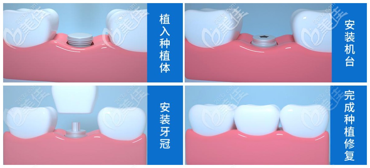 微创即刻种植牙和普通种植牙哪个好其区别在于它们的种植过程步骤哦