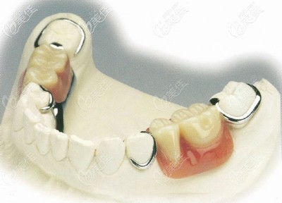能做纯钛吸附性义齿吗?