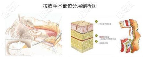 深圳艺星面部除皱方法有埋线提升和小切口拉皮皮肤松弛选哪个好