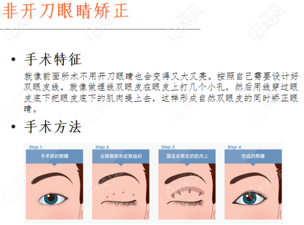 大眼睛的非开刀眼睛矫正术