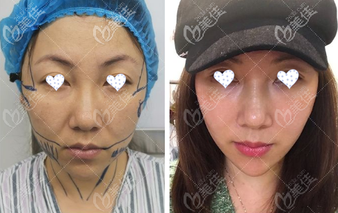 武汉美莱面部小切口拉皮手术15天照片对比
