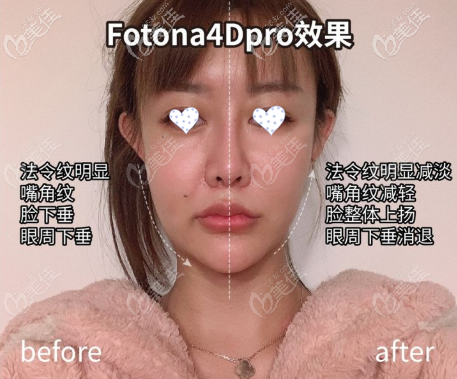 重庆华美fotona 4d pro全面部提升效果对比