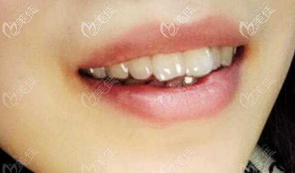 南京美奥连锁口腔的正畸医生朱峰技术怎么样上兔牙矫正一年变化案例图