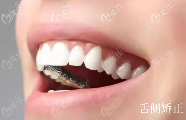 武汉各口腔医院矫正牙齿的价格上线,在武汉戴隐形牙套