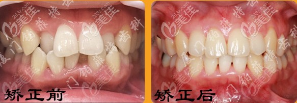 扒一扒厦门牙齿矫正医院排名,网友:这回知道整牙哪家牙科好了!