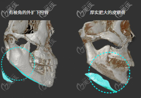 而下颌角截骨采用3d下颌综合成型术,做出来的整个下颌缘曲线非常顺滑