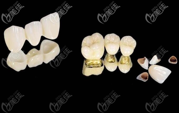 全瓷牙里的基牙能用多少年从基牙烂掉概率分析牙冠是否能用一辈子