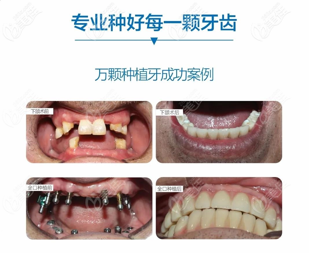 郑州唯美口腔医院种植牙咋样老爸在这做的全口即刻种植牙当天就能用啦
