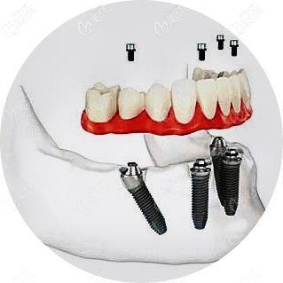 传统的种植牙都是先植入植体等3-6个月后再做牙齿,而即刻负重是当天