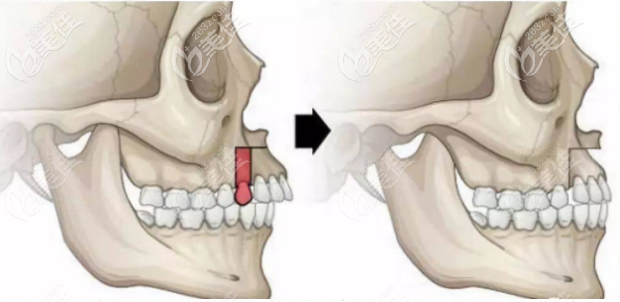 3,双颌前凸 手术方式:牙床骨凸出时,需要通过上颌前段截骨和下颌根尖