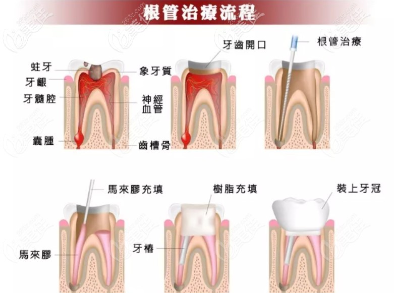 前牙后牙根管治疗过程流程图