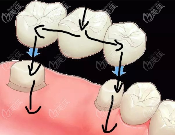 的位置打一颗金属钉(纯钛的)进去牙槽骨,金属钉长好之后在上面做牙冠