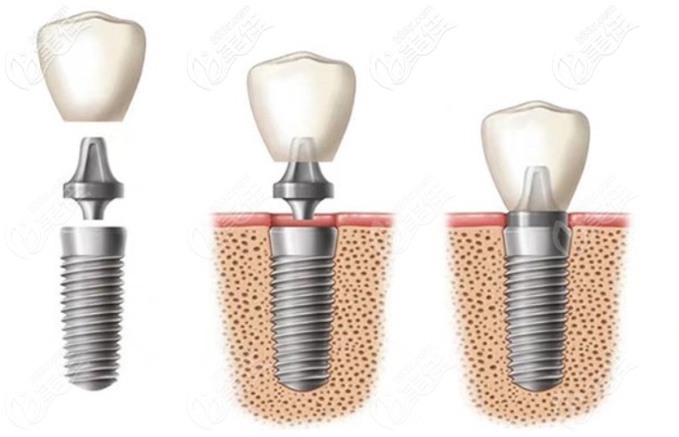 曝光南京卡瓦口腔种植牙价格表德国3d数字化导板种植牙技术了解一下