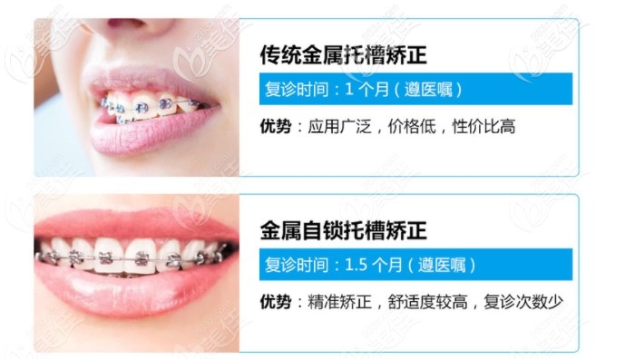 传统金属托槽和金属自锁托槽区别