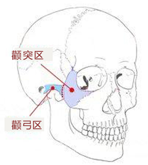 1) 手术方法 将颧突与颧弓都打断,并去除部分欲缩减的骨组织,并将颧骨