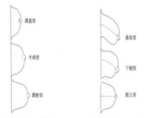 乳房的分型示意图2)已婚已育女性乳房分型①松垂型:乳房轻度萎缩,组织