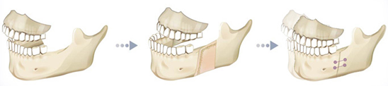 治疗方法: 颚部分为上颚和下颚,需要将骨骼全部断开后进行手术,所以