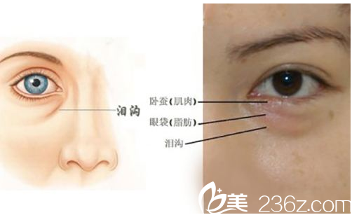 北京奥斯卡医疗美容医院眼袋示意图