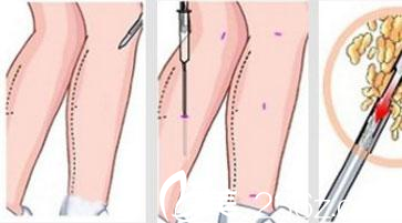 吸脂瘦小腿手术过程展示
