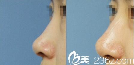 韩国yes整形外科医院黄泳重假体隆鼻做的好不好？硅胶隆鼻真人案例