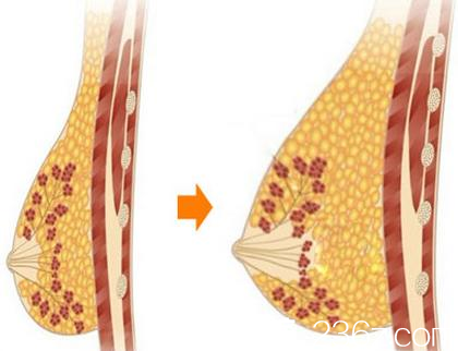 韩国麦恩医院自体脂肪丰胸前后对比